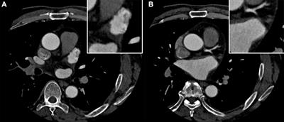 Case report: Artery of Percheron infarction as a rare complication during atrial fibrillation ablation